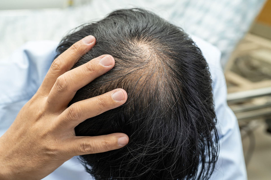 Vitamin D for Hair Regrowth